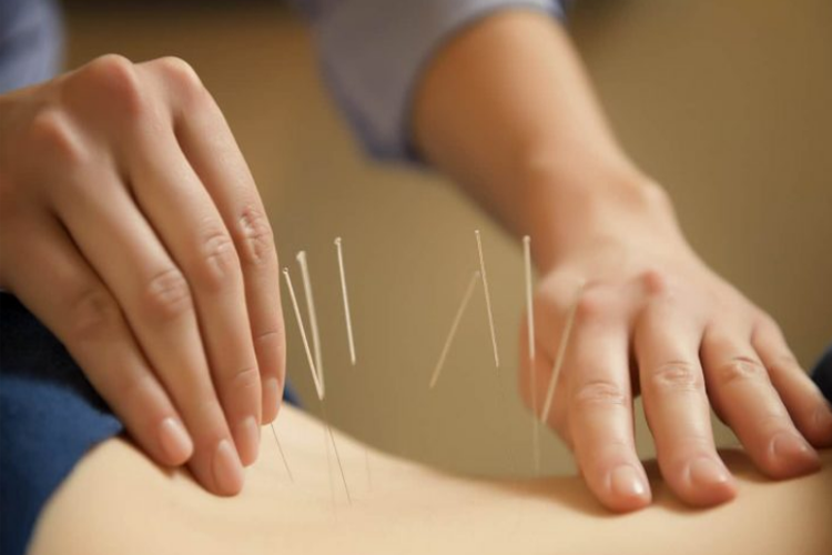 Điện mãng châm điều trị liệt chi dưới